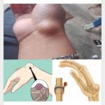 BE CAREFUL, if you get these bruises on your body, it means you have Ca…see more